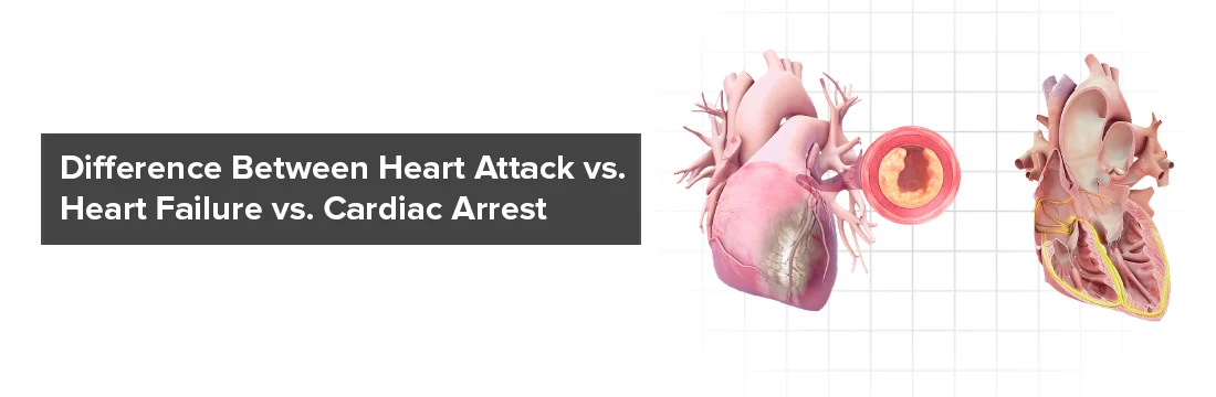 Difference Between Heart Attack vs. Heart Failure vs. Cardiac Arrest